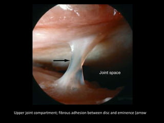 Upper joint compartment; fibrous adhesion between disc and eminence (arrow
 