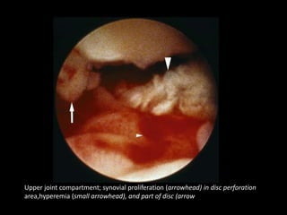 Upper joint compartment; synovial proliferation (arrowhead) in disc perforation
area,hyperemia (small arrowhead), and part of disc (arrow
 