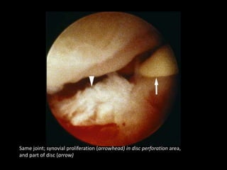 Same joint; synovial proliferation (arrowhead) in disc perforation area,
and part of disc (arrow)
 