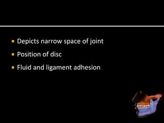  Depicts narrow space of joint
 Position of disc
 Fluid and ligament adhesion
 
