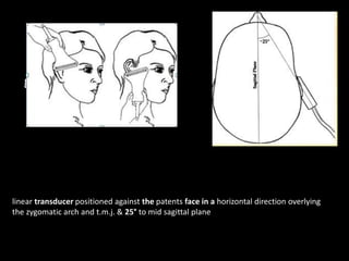 g
linear transducer positioned against the patents face in a horizontal direction overlying
the zygomatic arch and t.m.j. & 25° to mid sagittal plane
 