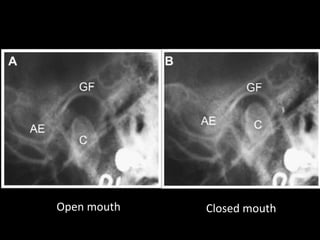 Open mouth Closed mouth
 