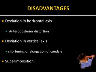  Deviation in horizontal axis
 Anteroposterior distortion
 Deviation in vertical axis
 shortening or elongation of condyle
 Superimposition
 