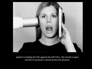 patient is holding the film against the left T.M.J., the mouth is open
and the X-ray beam is aimed across the pharynx.
 