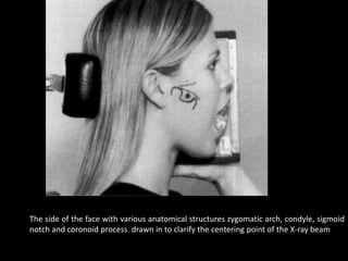 The side of the face with various anatomical structures zygomatic arch, condyle, sigmoid
notch and coronoid process drawn in to clarify the centering point of the X-ray beam
 