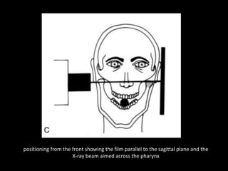 positioning from the front showing the film parallel to the sagittal plane and the
X-ray beam aimed across the pharynx
 