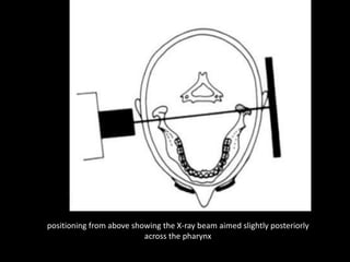 positioning from above showing the X-ray beam aimed slightly posteriorly
across the pharynx
 