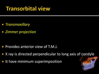  Transmaxillary
 Zimmer projection
 Provides anterior view of T.M.J.
 X ray is directed perpendicular to long axis of condyle
 It have minimum superimposition
 