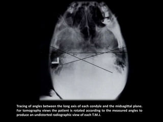 Tracing of angles between the long axis of each condyle and the midsagittal plane.
For tomography views the patient is rotated according to the measured angles to
produce an undistorted radiographic view of each T.M.J.
 