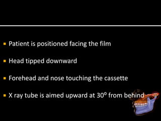  Patient is positioned facing the film
 Head tipped downward
 Forehead and nose touching the cassette
 X ray tube is aimed upward at 30⁰ from behind
 