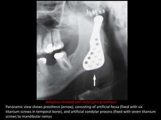 Ankylosis treated with total joint prosthesis
Panoramic view shows prosthesis (arrow), consisting of artificial fossa (fixed with six
titanium screws in temporal bone), and artificial condylar process (fixed with seven titanium
screws to mandibular ramus
 
