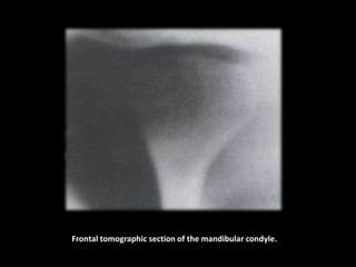 Frontal tomographic section of the mandibular condyle.
 