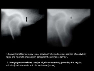 1.Conventional tomography 1 year previously showed normal position of condyle in
fossa and normal bone; note in particular the eminence (arrow).
2.Tomography now shows condyle displaced anteriorly (probably due to joint
effusion) and erosion in articular eminence (arrow)
 