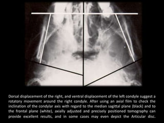 Dorsal displacement of the right, and ventral displacement of the left condyle suggest a
rotatory movement around the right condyle. After using an axial film to check the
inclination of the condylar axis with regard to the median sagittal plane (black) and to
the frontal plane (white), axially adjusted and precisely positioned tomography can
provide excellent results, and in some cases may even depict the Articular disc.
 