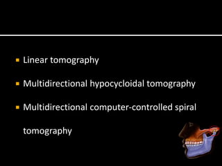  Linear tomography
 Multidirectional hypocycloidal tomography
 Multidirectional computer-controlled spiral
tomography
 
