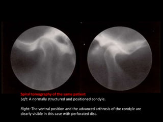 Spiral tomography of the same patient
Left: A normally structured and positioned condyle.
Right: The ventral position and the advanced arthrosis of the condyle are
clearly visible in this case with perforated disc.
 