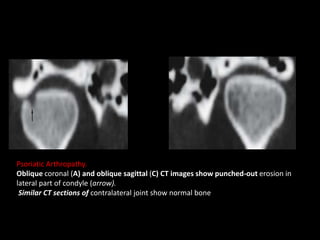 Psoriatic Arthropathy.
Oblique coronal (A) and oblique sagittal (C) CT images show punched-out erosion in
lateral part of condyle (arrow).
Similar CT sections of contralateral joint show normal bone
 