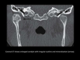 Coronal CT shows enlarged condyle with irregular outline and mineralization (arrow).
 