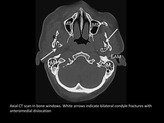 Axial CT scan in bone windows. White arrows indicate bilateral condyle fractures with
anteromedial dislocation
 