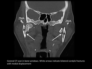 Coronal CT scan in bone windows. White arrows indicate bilateral condyle fractures
with medial displacement
 