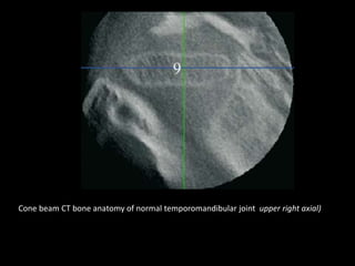 Cone beam CT bone anatomy of normal temporomandibular joint upper right axial)
 