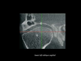 lower left oblique sagittal
 