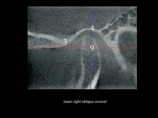 lower right oblique coronal
 