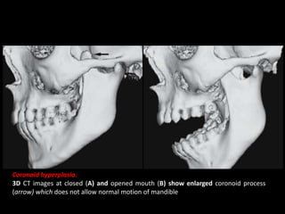 Coronoid hyperplasia.
3D CT images at closed (A) and opened mouth (B) show enlarged coronoid process
(arrow) which does not allow normal motion of mandible
 