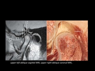 upper left oblique sagittal MRI, upper right oblique coronal MRI,
 