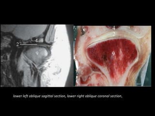 lower left oblique sagittal section, lower right oblique coronal section,
 