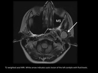 T1-weighted axial MRI. White arrow indicates cystic lesion of the left condyle with fluid levels.
 