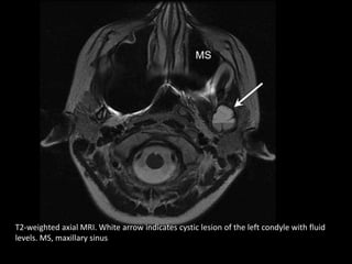 T2-weighted axial MRI. White arrow indicates cystic lesion of the left condyle with fluid
levels. MS, maxillary sinus
 