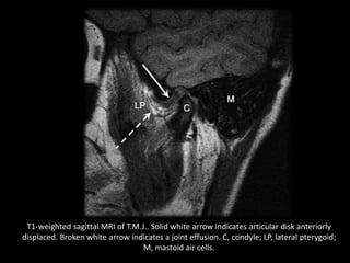 T1-weighted sagittal MRI of T.M.J.. Solid white arrow indicates articular disk anteriorly
displaced. Broken white arrow indicates a joint effusion. C, condyle; LP, lateral pterygoid;
M, mastoid air cells.
 