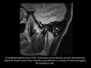T2-weighted sagittal view of T.M.J.. Solid white arrow indicates articular disk anteriorly
displaced. Broken white arrow indicates a joint effusion. C, condyle; LP, lateral pterygoid;
M, mastoid air cells.
 