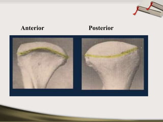 Anterior Posterior 
 
