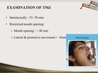 EXAMINATION OF TMJ 
• Interincisally : 53- 58 mm 
• Restricted mouth opening: 
– Mouth opening : < 40 mm 
– Lateral & protrusive movement:< 8mm 
 