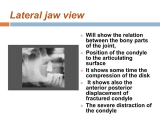 Tmj disorders | PDF