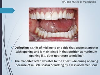 Tmj Deviation Deflection Temporomandibular joint Muscles of Mastication | PPTX