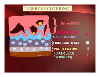 TUBERCLE COVERING


                Dense BONE

             OSSIFICATION
                             IV
         } CALCIFICATION

          }FIBROCARTILAGE    III
          }PROLIFERATIVE     II
             } ARTICULAR      I
              (FIBROUS)
 