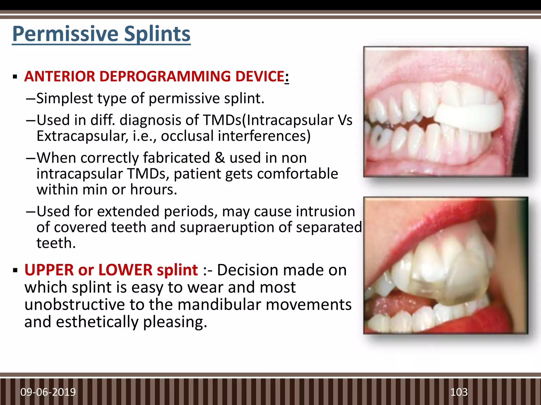 Permissive Splints
 ANTERIOR DEPROGRAMMING DEVICE:
–Simplest type of permissive splint.
–Used in diff. diagnosis of TMDs(Intracapsular Vs
Extracapsular, i.e., occlusal interferences)
–When correctly fabricated & used in non
intracapsular TMDs, patient gets comfortable
within min or hrours.
–Used for extended periods, may cause intrusion
of covered teeth and supraeruption of separated
teeth.
 UPPER or LOWER splint :- Decision made on
which splint is easy to wear and most
unobstructive to the mandibular movements
and esthetically pleasing.
09-06-2019 103
 