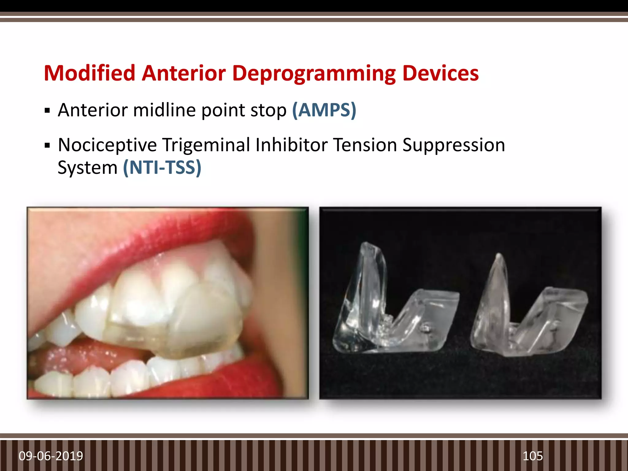 Modified Anterior Deprogramming Devices
 Anterior midline point stop (AMPS)
 Nociceptive Trigeminal Inhibitor Tension Suppression
System (NTI-TSS)
09-06-2019 105
 