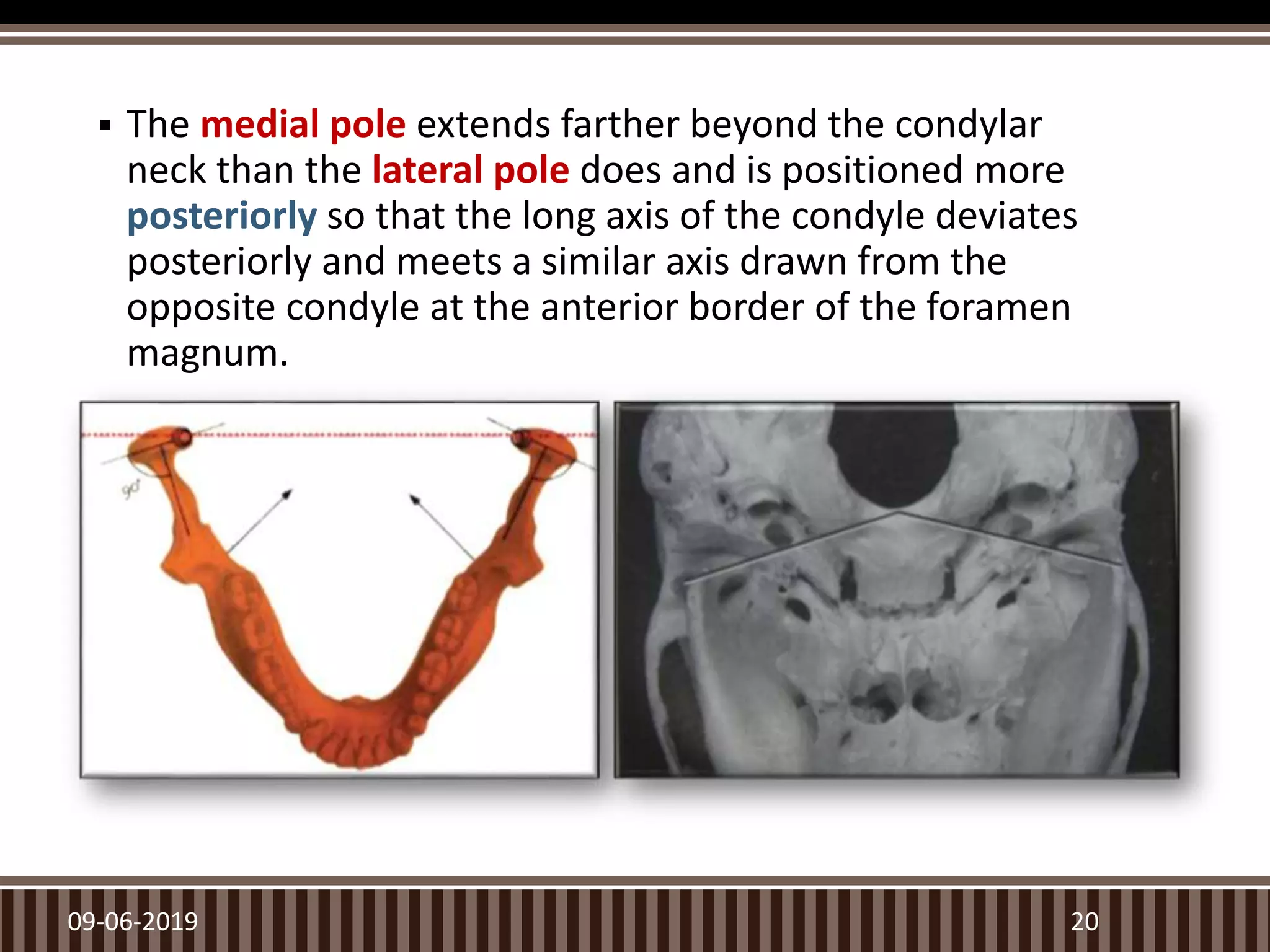  The medial pole extends farther beyond the condylar
neck than the lateral pole does and is positioned more
posteriorly so that the long axis of the condyle deviates
posteriorly and meets a similar axis drawn from the
opposite condyle at the anterior border of the foramen
magnum.
09-06-2019 20
 