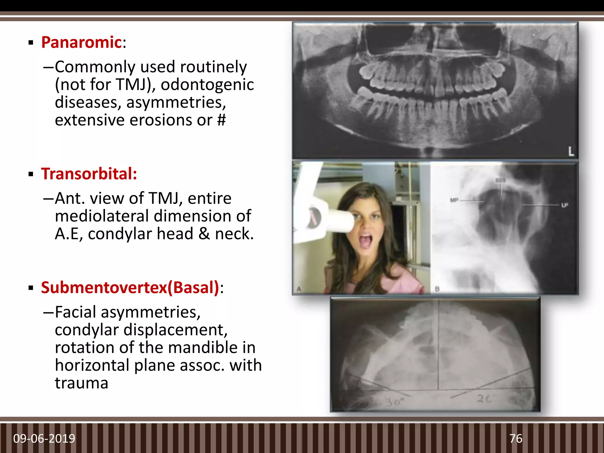  Panaromic:
–Commonly used routinely
(not for TMJ), odontogenic
diseases, asymmetries,
extensive erosions or #
 Transorbital:
–Ant. view of TMJ, entire
mediolateral dimension of
A.E, condylar head & neck.
 Submentovertex(Basal):
–Facial asymmetries,
condylar displacement,
rotation of the mandible in
horizontal plane assoc. with
trauma
09-06-2019 76
 