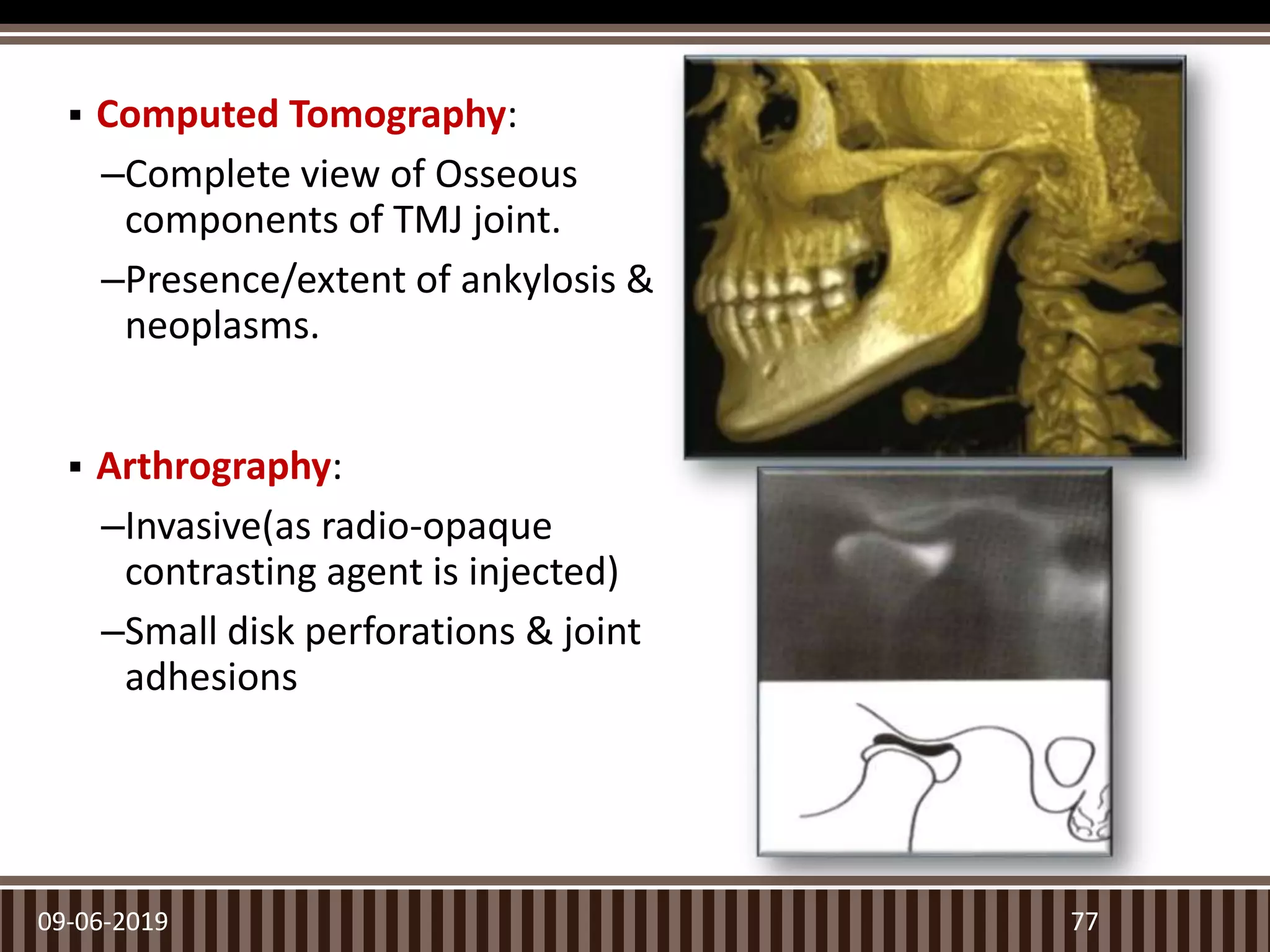  Computed Tomography:
–Complete view of Osseous
components of TMJ joint.
–Presence/extent of ankylosis &
neoplasms.
 Arthrography:
–Invasive(as radio-opaque
contrasting agent is injected)
–Small disk perforations & joint
adhesions
09-06-2019 77
 
