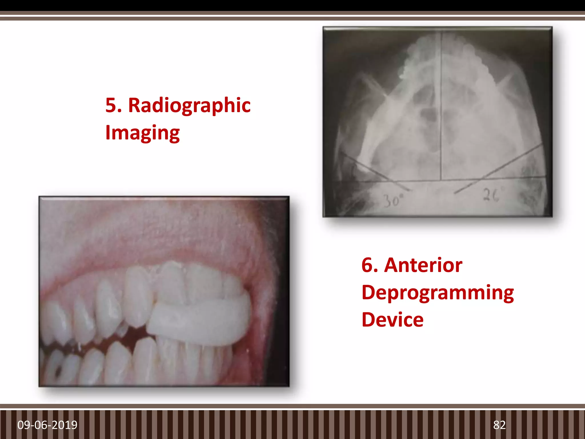 09-06-2019 82
5. Radiographic
Imaging
6. Anterior
Deprogramming
Device
 