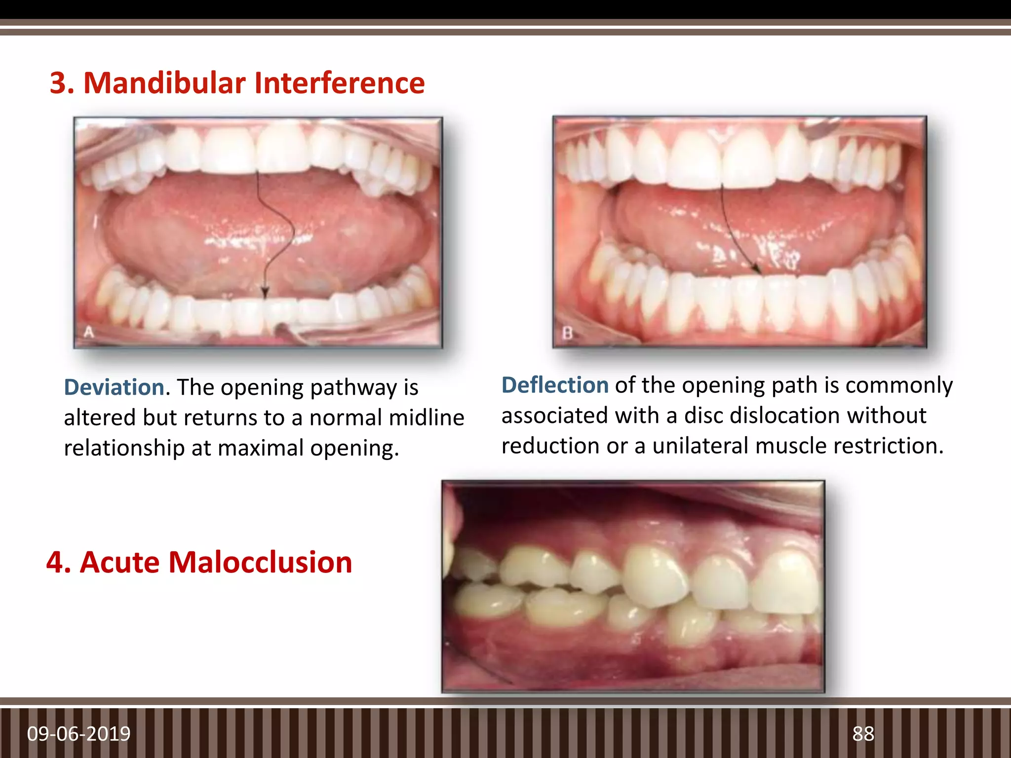 3. Mandibular Interference
09-06-2019 88
Deviation. The opening pathway is
altered but returns to a normal midline
relationship at maximal opening.
Deflection of the opening path is commonly
associated with a disc dislocation without
reduction or a unilateral muscle restriction.
4. Acute Malocclusion
 