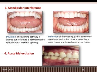 Tmj Deviation Deflection TMJ and Its Applied Aspects in Prosthodontics | PPTX