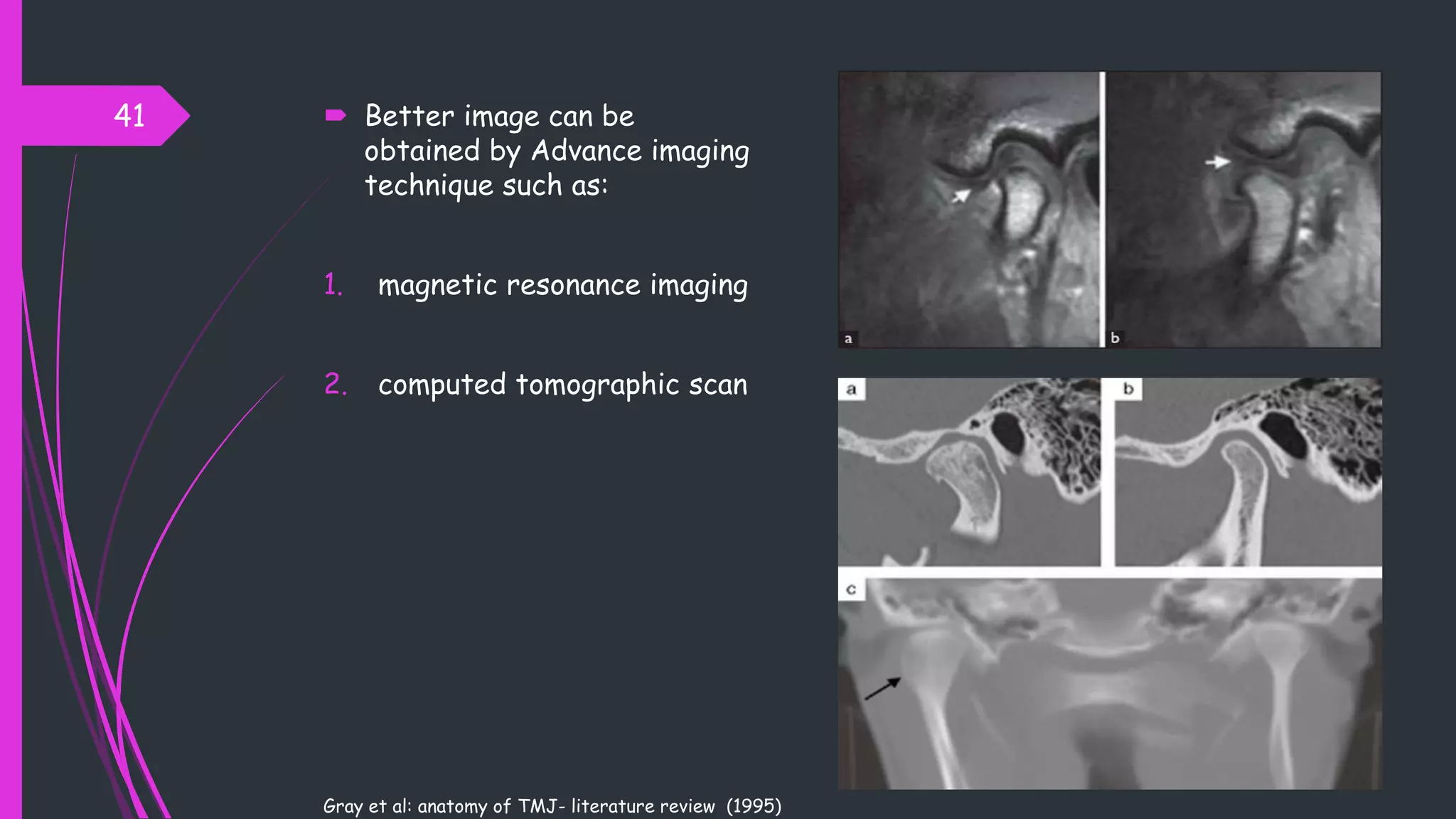  Better image can be
obtained by Advance imaging
technique such as:
1. magnetic resonance imaging
2. computed tomographic scan
41
Gray et al: anatomy of TMJ- literature review (1995)
 