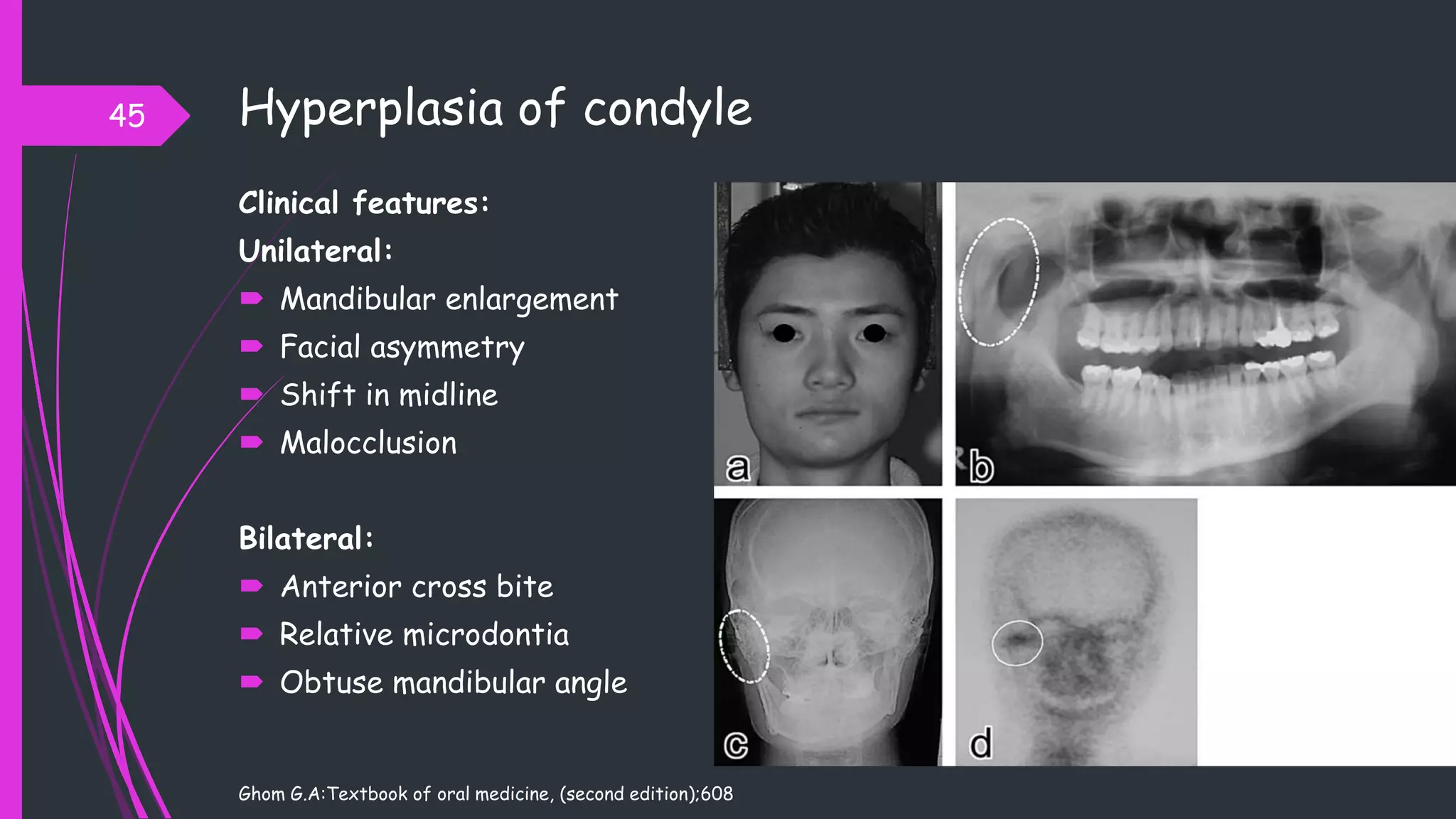 Hyperplasia of condyle
Clinical features:
Unilateral:
 Mandibular enlargement
 Facial asymmetry
 Shift in midline
 Malocclusion
Bilateral:
 Anterior cross bite
 Relative microdontia
 Obtuse mandibular angle
Ghom G.A:Textbook of oral medicine, (second edition);608
45
 