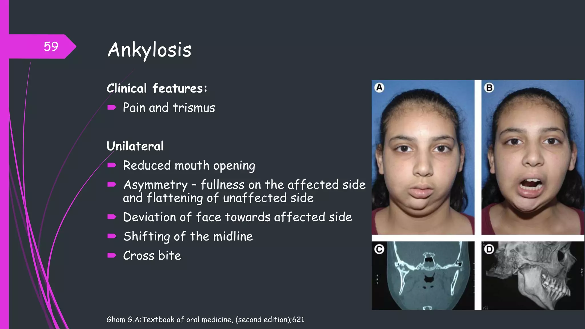 Ankylosis
Clinical features:
 Pain and trismus
Unilateral
 Reduced mouth opening
 Asymmetry – fullness on the affected side
and flattening of unaffected side
 Deviation of face towards affected side
 Shifting of the midline
 Cross bite
Ghom G.A:Textbook of oral medicine, (second edition);621
59
 
